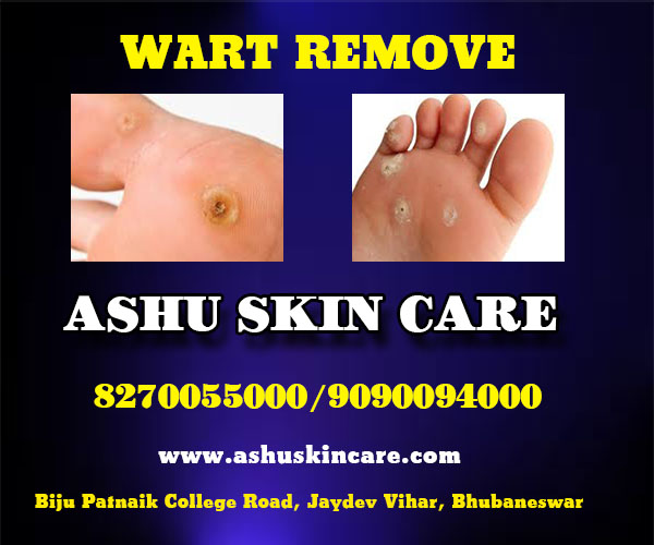 best wart remove clinic in bhubaneswar near me